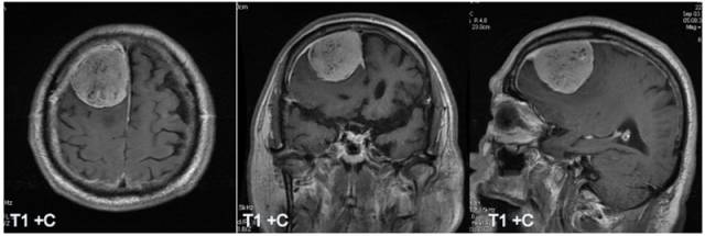 15种亚型脑膜瘤影像表现及诊断要点