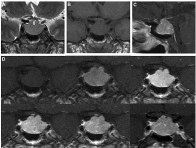 15种亚型脑膜瘤影像表现及诊断要点