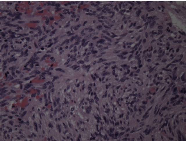 15种亚型脑膜瘤影像表现及诊断要点