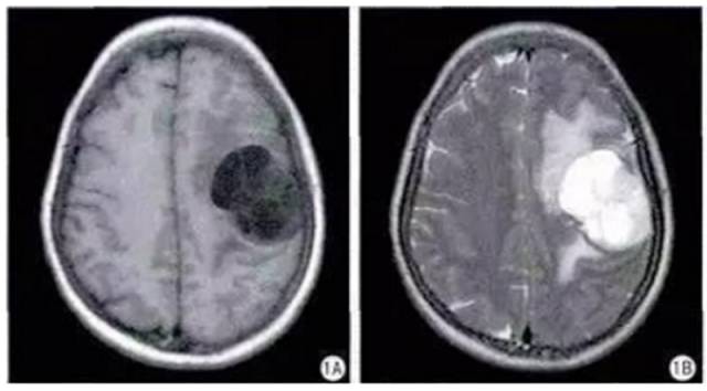 15种亚型脑膜瘤影像表现及诊断要点