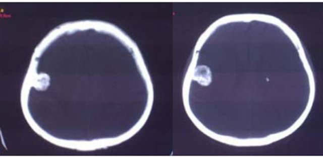 15种亚型脑膜瘤影像表现及诊断要点