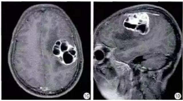 15种亚型脑膜瘤影像表现及诊断要点