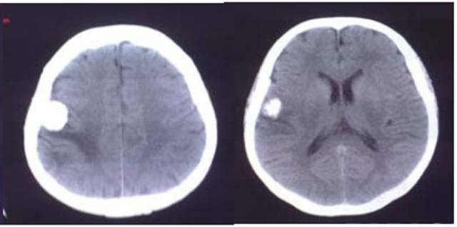 15种亚型脑膜瘤影像表现及诊断要点