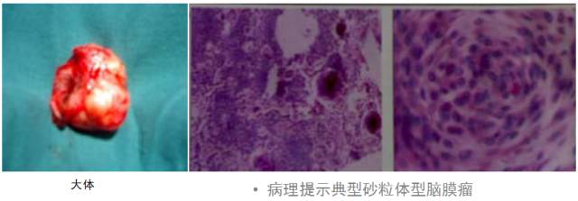 15种亚型脑膜瘤影像表现及诊断要点