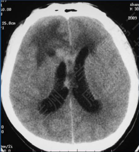 15种亚型脑膜瘤影像表现及诊断要点