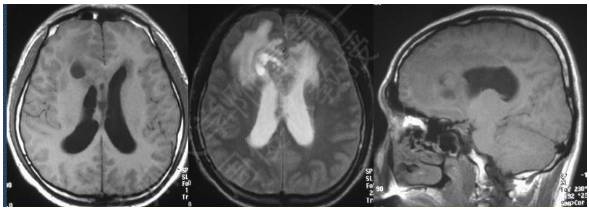 15种亚型脑膜瘤影像表现及诊断要点