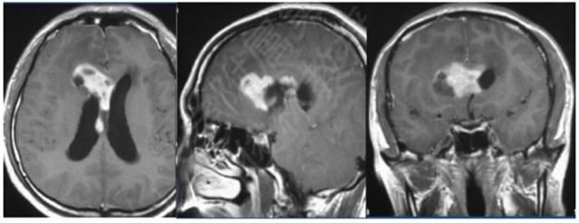 15种亚型脑膜瘤影像表现及诊断要点