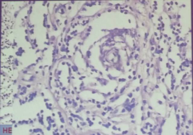 15种亚型脑膜瘤影像表现及诊断要点