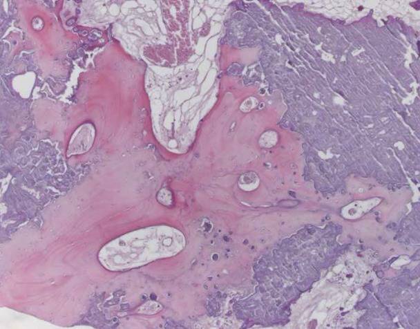 15种亚型脑膜瘤影像表现及诊断要点