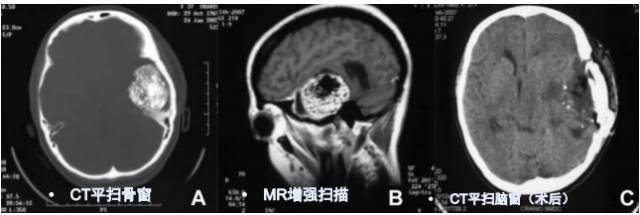 15种亚型脑膜瘤影像表现及诊断要点