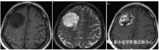 15种亚型脑膜瘤影像表现及诊断要点