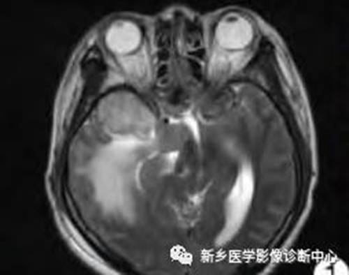 15种亚型脑膜瘤影像表现及诊断要点