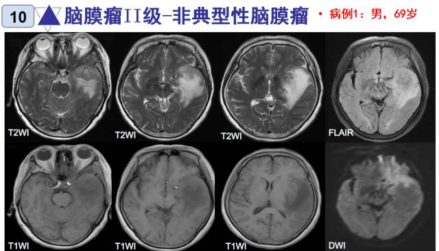 15种亚型脑膜瘤影像表现及诊断要点
