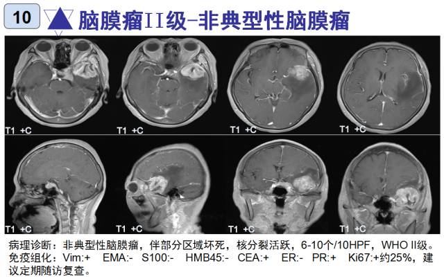 15种亚型脑膜瘤影像表现及诊断要点