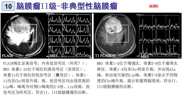 15种亚型脑膜瘤影像表现及诊断要点