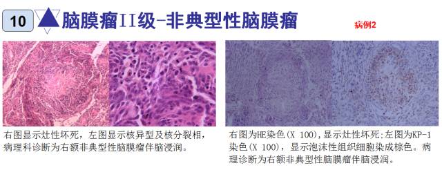 15种亚型脑膜瘤影像表现及诊断要点