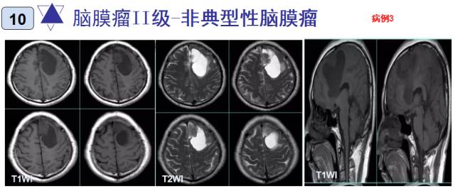 15种亚型脑膜瘤影像表现及诊断要点