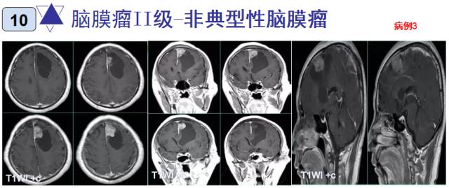 15种亚型脑膜瘤影像表现及诊断要点