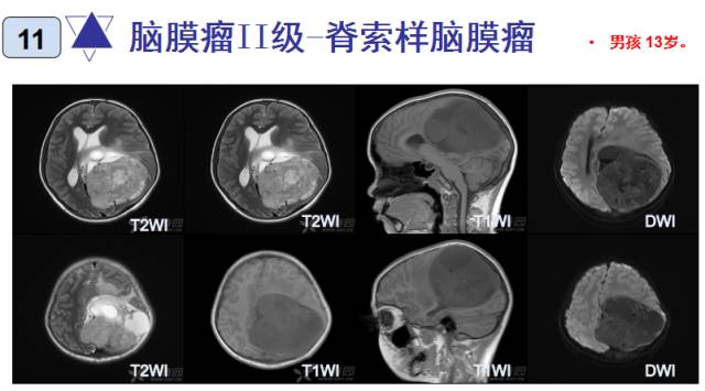 15种亚型脑膜瘤影像表现及诊断要点