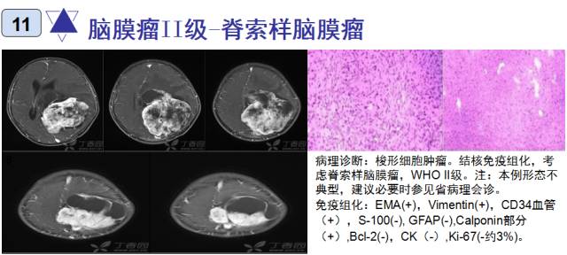 15种亚型脑膜瘤影像表现及诊断要点