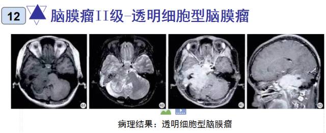 15种亚型脑膜瘤影像表现及诊断要点