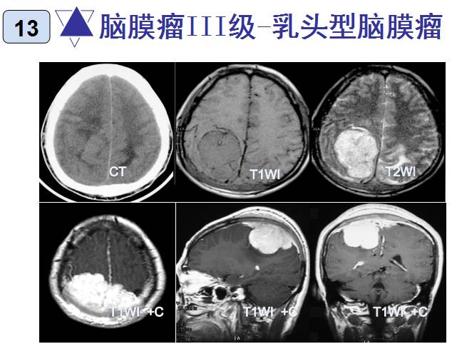 15种亚型脑膜瘤影像表现及诊断要点
