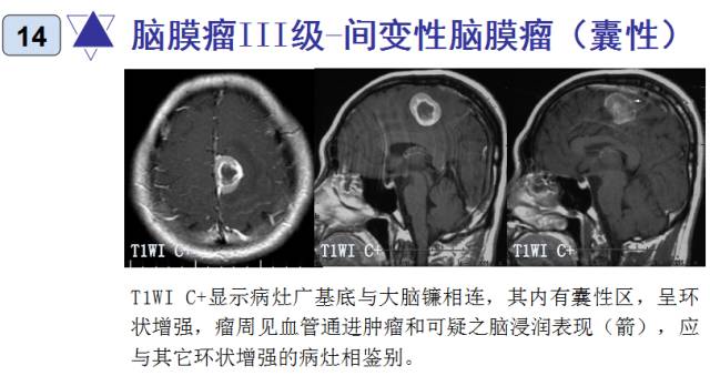 15种亚型脑膜瘤影像表现及诊断要点