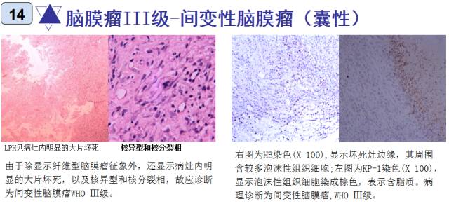 15种亚型脑膜瘤影像表现及诊断要点