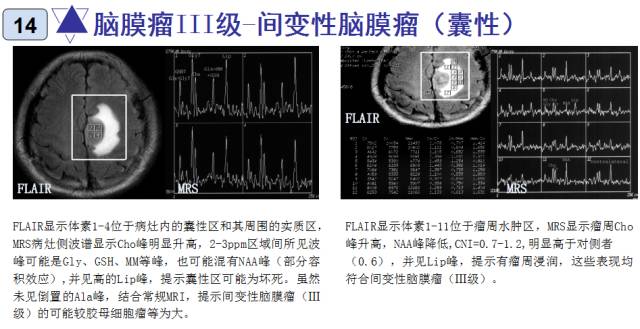 15种亚型脑膜瘤影像表现及诊断要点