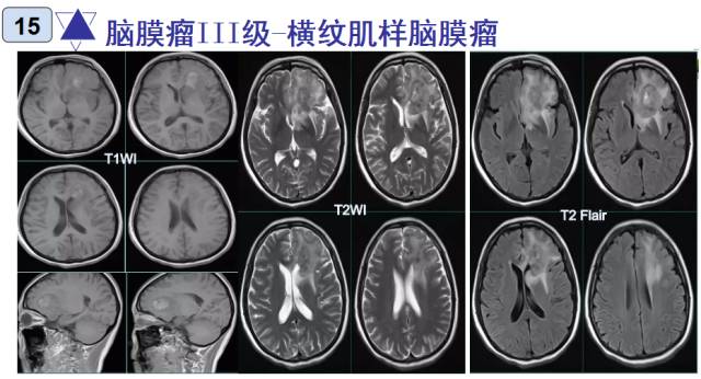 15种亚型脑膜瘤影像表现及诊断要点