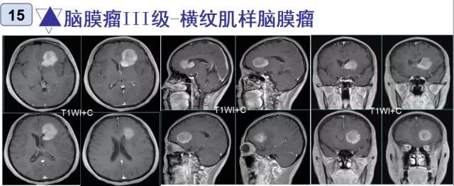 15种亚型脑膜瘤影像表现及诊断要点