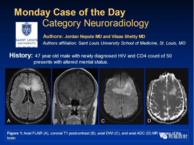 【病例】进行性多灶性白质脑病PML三例MR影像表现