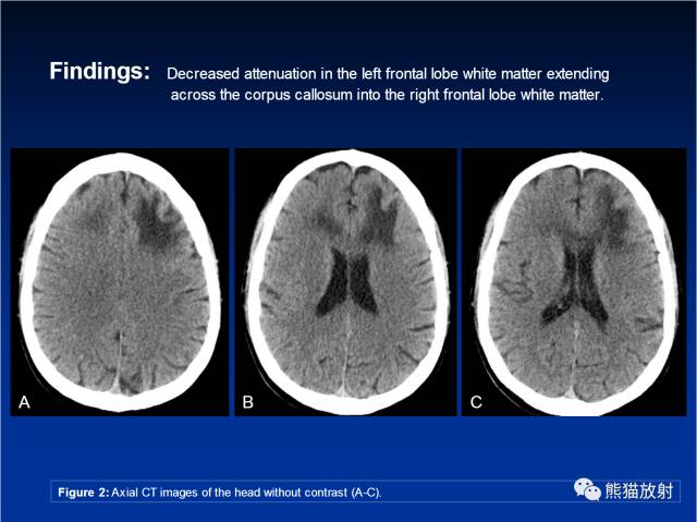 【病例】进行性多灶性白质脑病PML三例MR影像表现