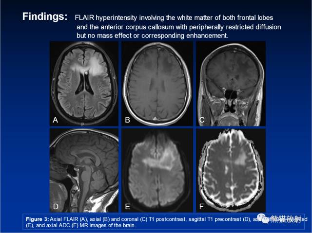 【病例】进行性多灶性白质脑病PML三例MR影像表现