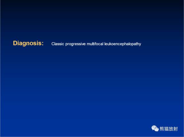 【病例】进行性多灶性白质脑病PML三例MR影像表现