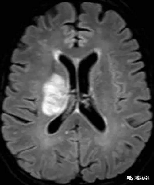 【病例】进行性多灶性白质脑病PML三例MR影像表现