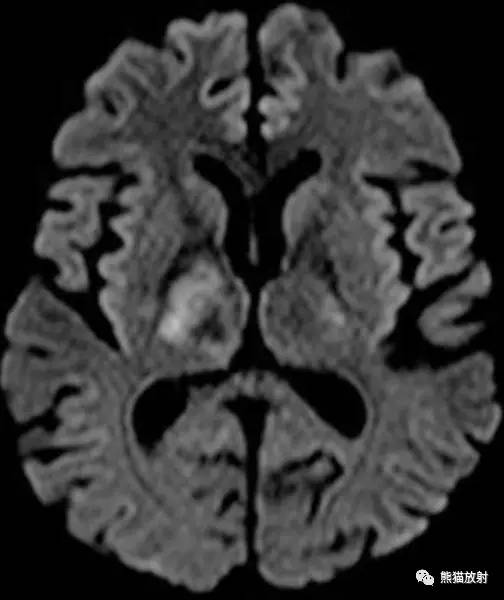 【病例】进行性多灶性白质脑病PML三例MR影像表现