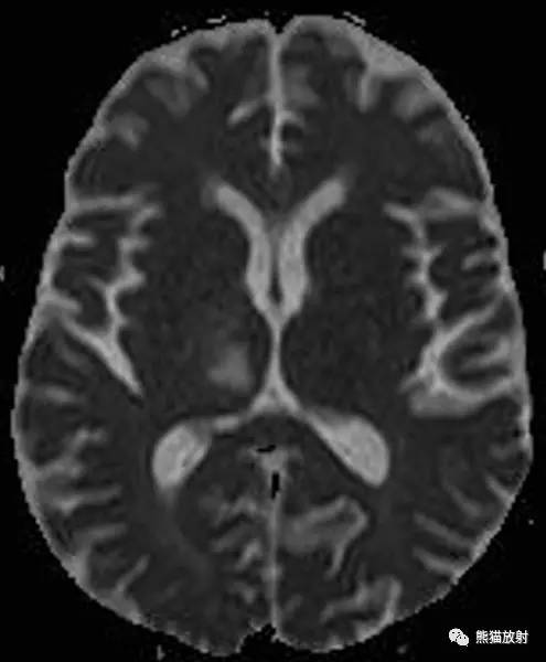 【病例】进行性多灶性白质脑病PML三例MR影像表现