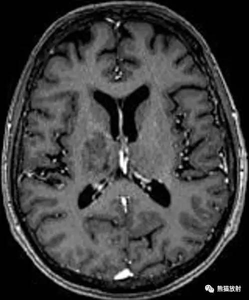 【病例】进行性多灶性白质脑病PML三例MR影像表现