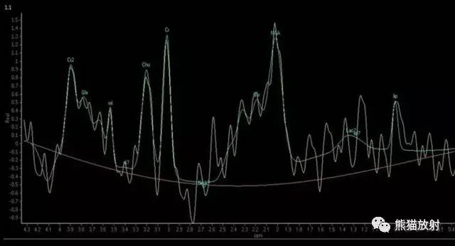 【病例】进行性多灶性白质脑病PML三例MR影像表现