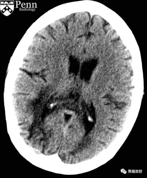【病例】进行性多灶性白质脑病PML三例MR影像表现