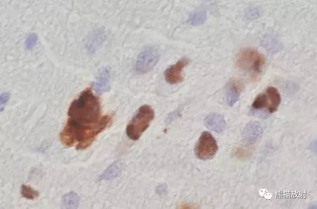 【病例】进行性多灶性白质脑病PML三例MR影像表现