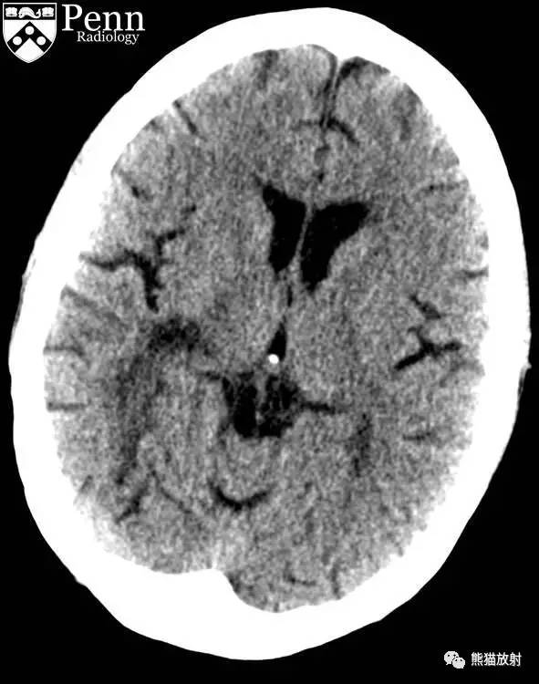 【病例】进行性多灶性白质脑病PML三例MR影像表现
