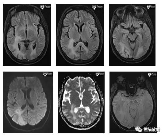 【病例】进行性多灶性白质脑病PML三例MR影像表现