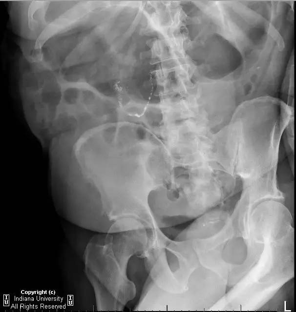 【病例】阑尾内对比剂充填1例X线CT影像表现