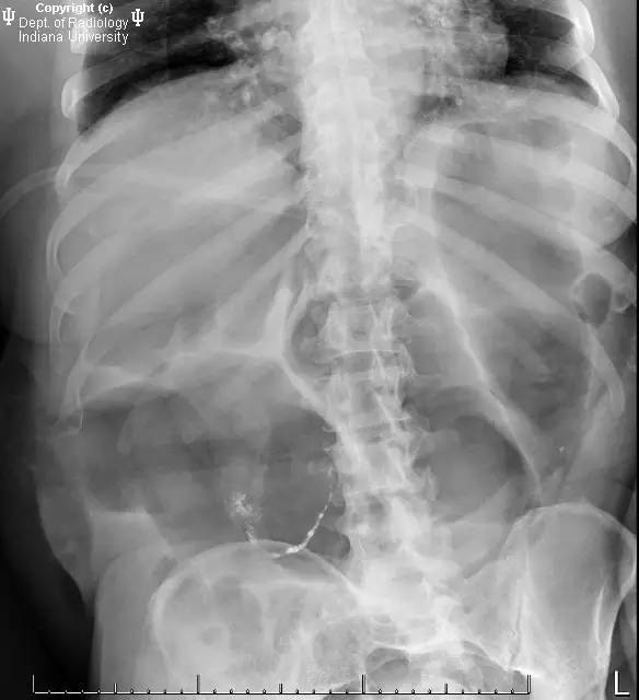 【病例】阑尾内对比剂充填1例X线CT影像表现