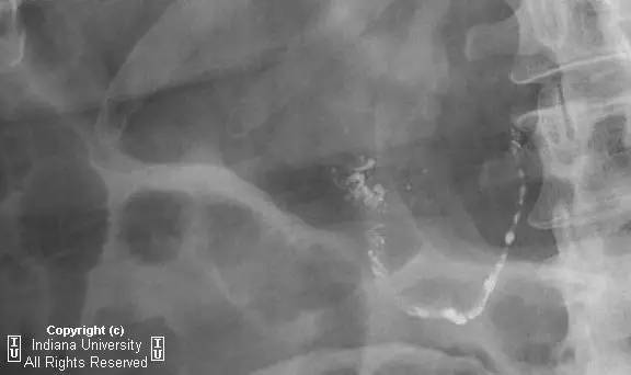 【病例】阑尾内对比剂充填1例X线CT影像表现