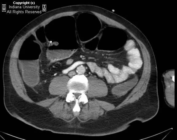 【病例】阑尾内对比剂充填1例X线CT影像表现