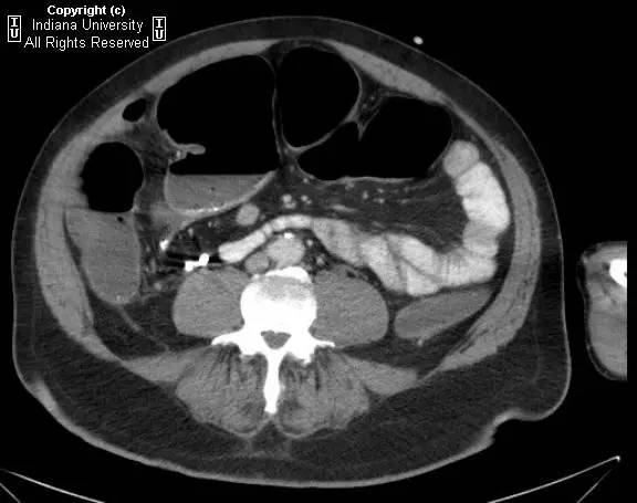 【病例】阑尾内对比剂充填1例X线CT影像表现