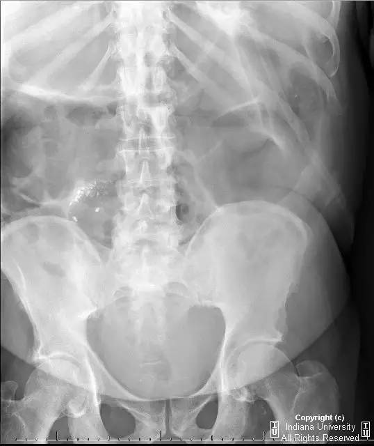 【病例】阑尾内对比剂充填1例X线CT影像表现